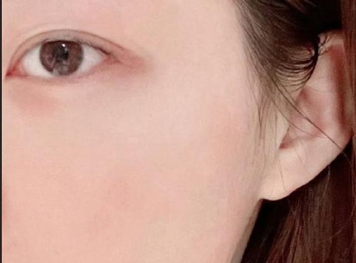 Eye Puffiness Emergency Patch